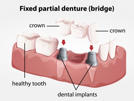 Santa Rosa Dentist Bridges