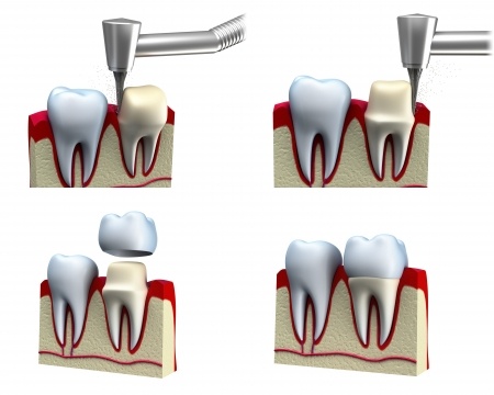 Santa Rosa Dentist Crown 