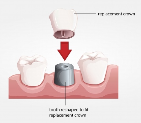 Santa Rosa Dentist Implant Crown